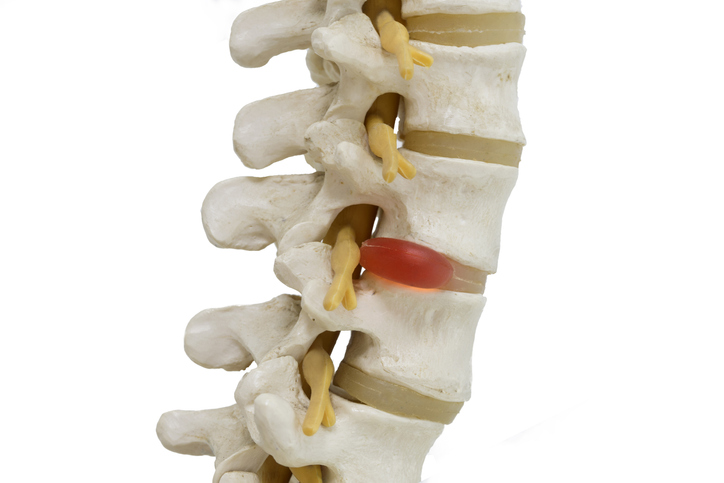 Suffering from a Herniated Disc After Car Accident?